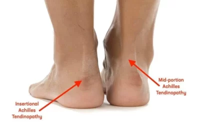 Tendonitis and tenosynovitis