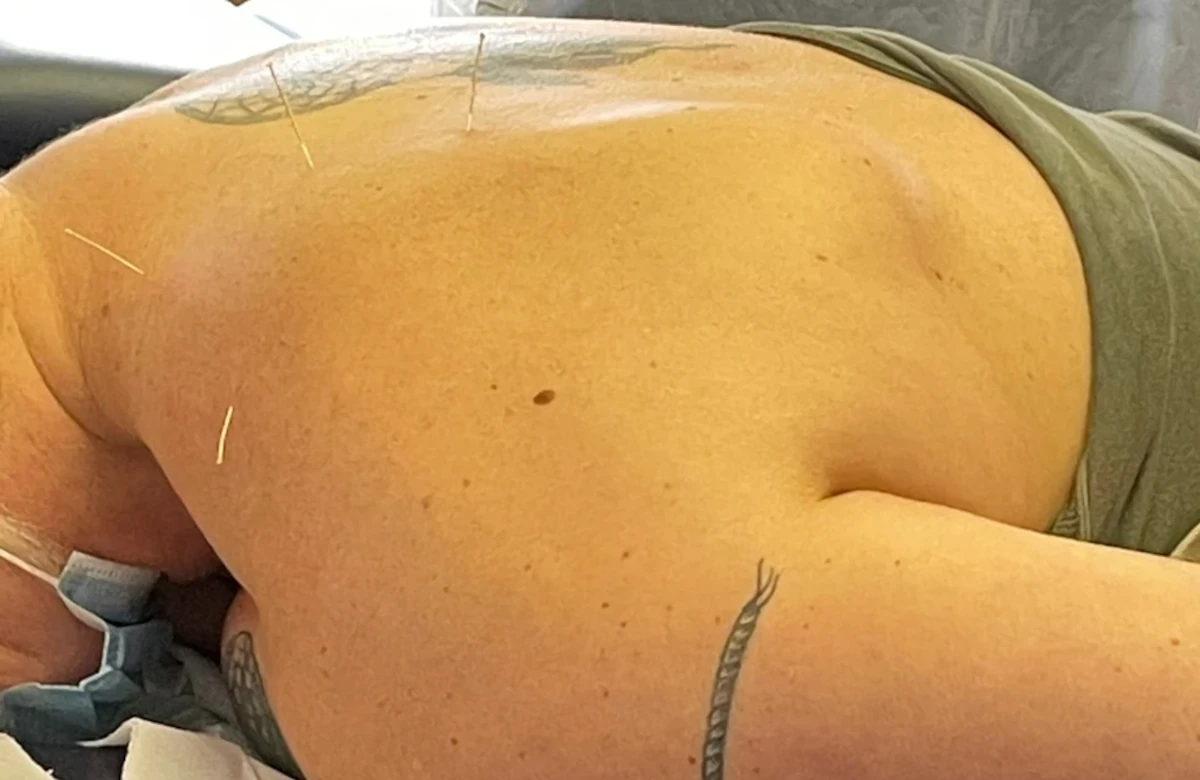 dryneedling 01 Dry Needling