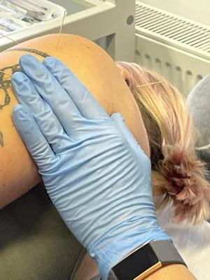 Dry needling in the shoulder
