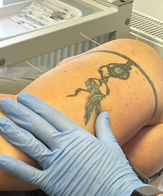 Shoulder and Arm Treatment