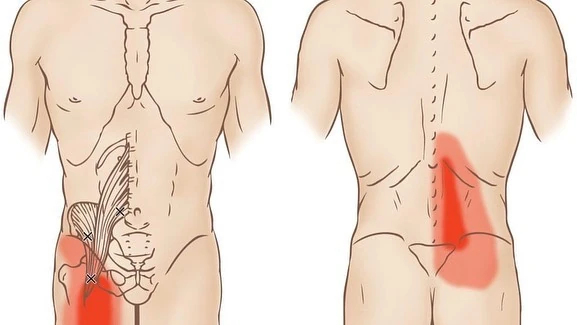 Psoas and quadratus lumborum