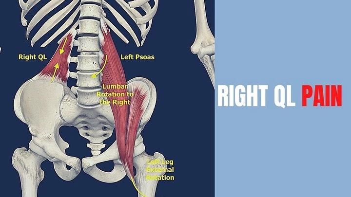 Psoas and quadratus lumborum