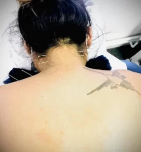 Acupuncture - Neck treatment