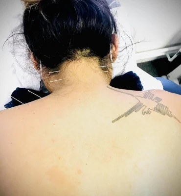 Acupuncture - Neck treatment