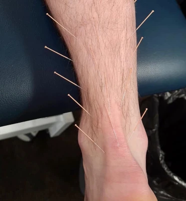 Ankle treatment