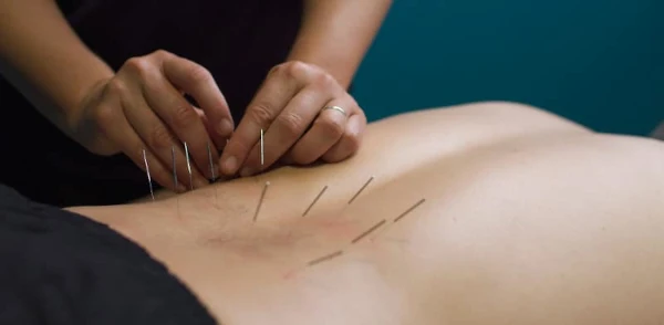 Acupunture Treatment