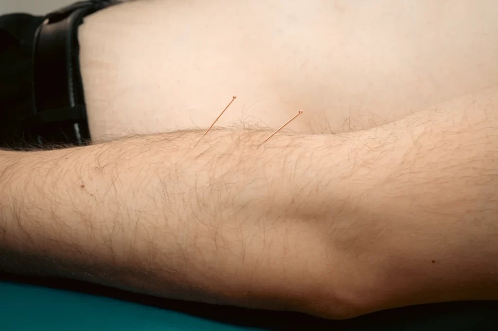 Acupuncture