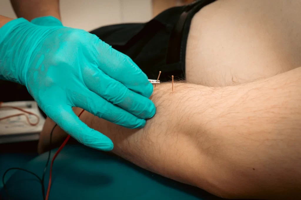 Acupuncture