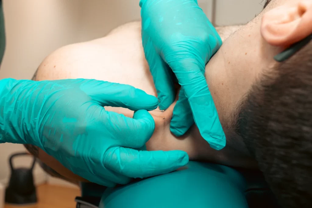 Dry needling