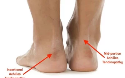 Achilles Tendinitis and treatments