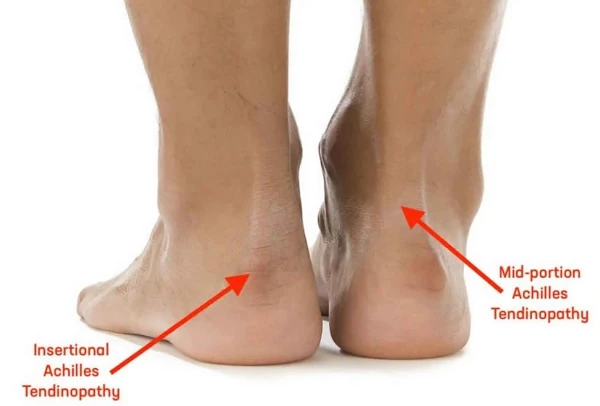 Achilles Tendinitis and treatments