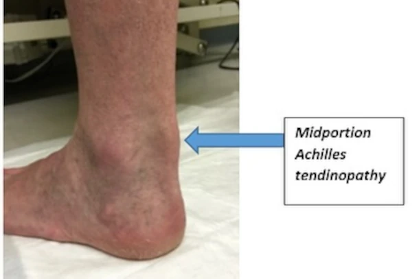 Bursitis on the achilles tendon
