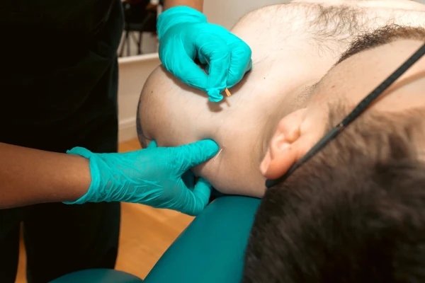 Acupuncture in the shoulder