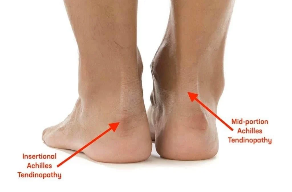 Tendonitis vs Tenosynovitis: What Is the Difference?