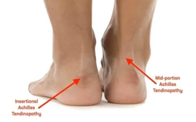 Tendonitis vs Tenosynovitis: What Is the Difference?