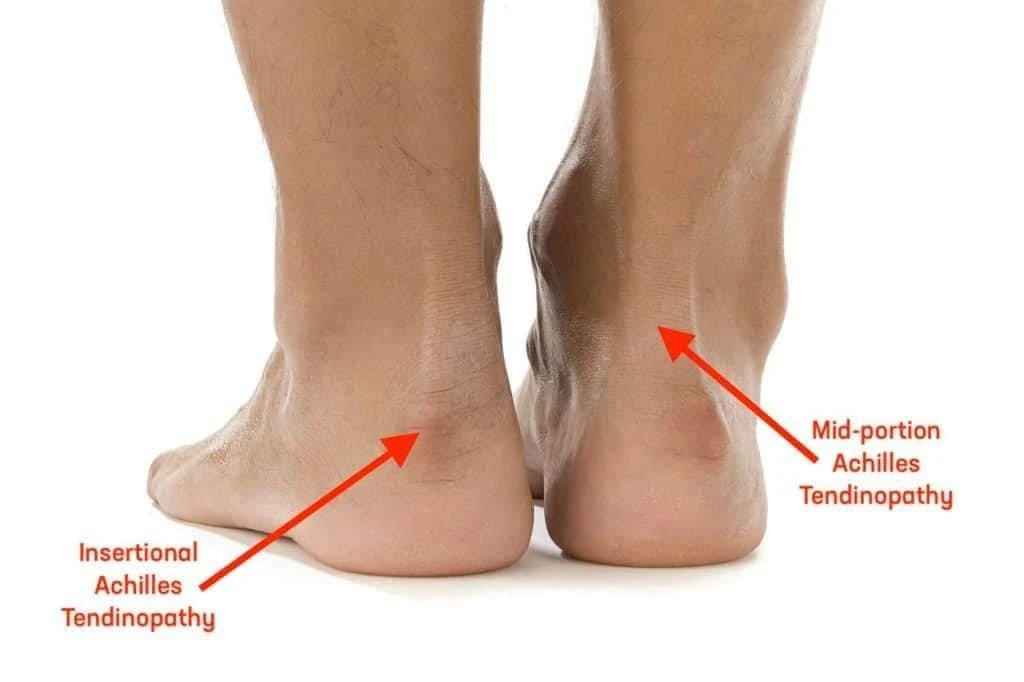 src-103120-Achilles-02 Diagram of the heel showing insertional and mid-portion Achilles tendinopathy