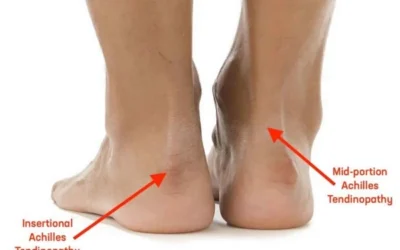 Achilles Tendinitis: Symptoms, Causes and How Physiotherapy Treats It